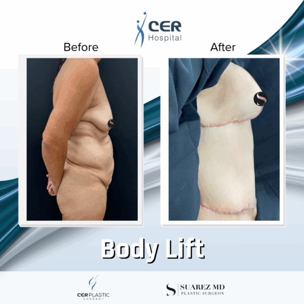 Body Lift - 9104 - Image 9
