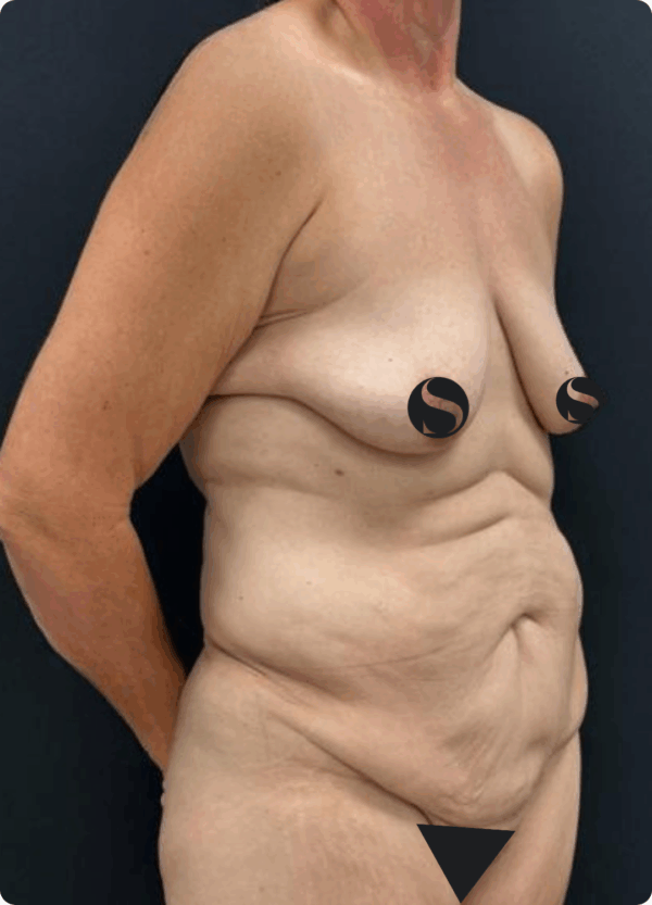 Body Lift - 9104 - Image 3