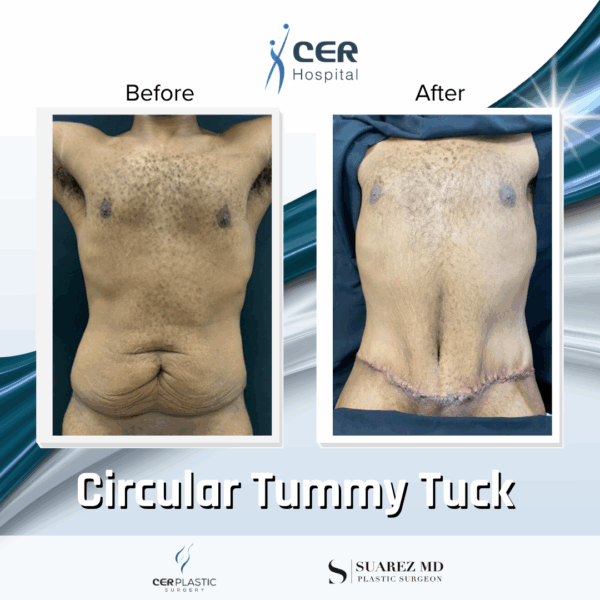 Circular Tummy Tuck - 11104 - Image 6