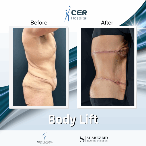 Body Lift - 3074 - Image 6