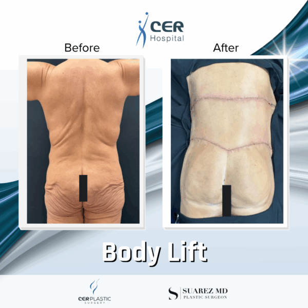 Body Lift - 0608 - Image 5