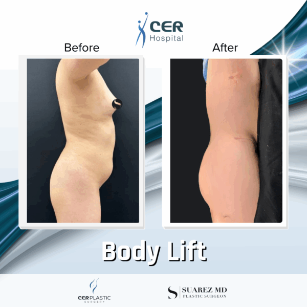 Body Lift - 22054 - Image 5
