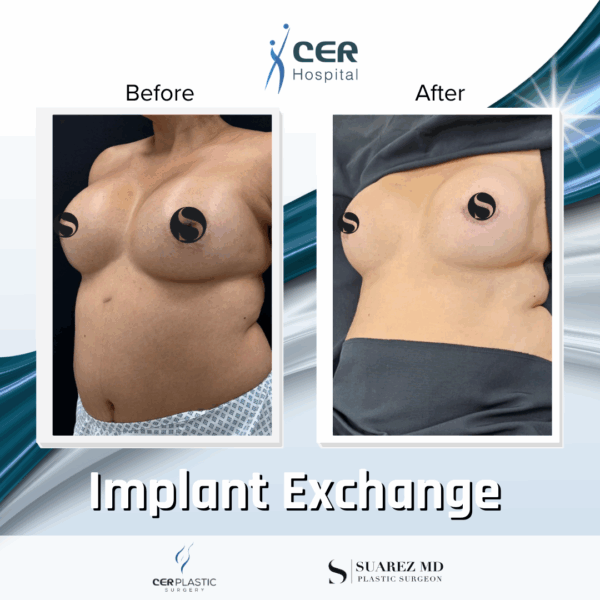 Implant Exchange - 24054 - Image 6