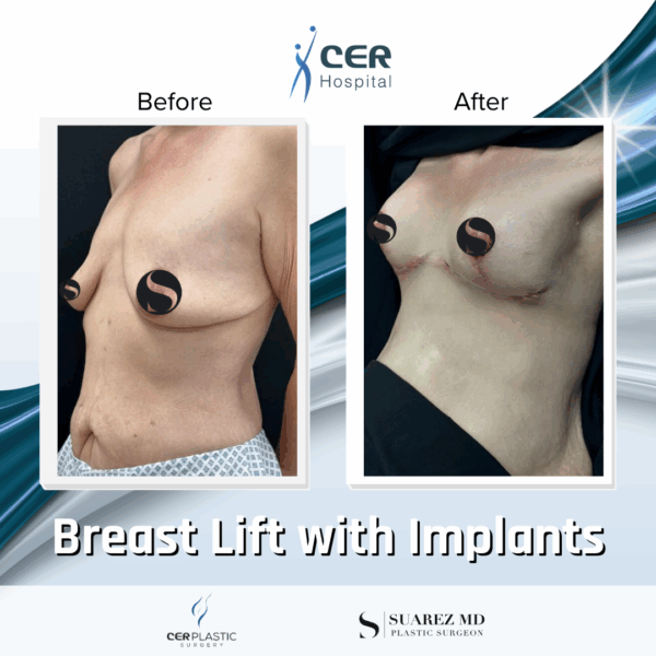Breast Lift with Implants - 24054 - Image 6
