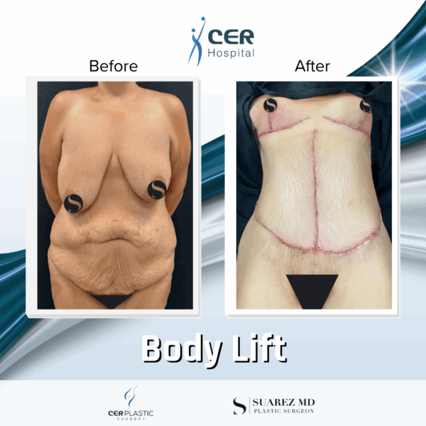 Body Lift - 31074 - Image 5
