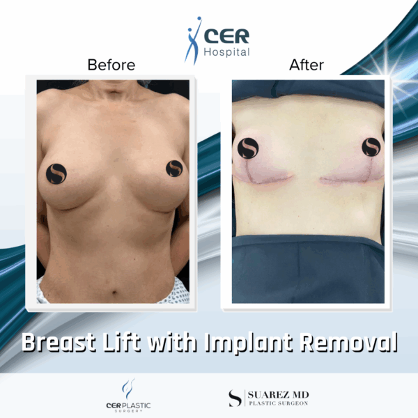 Breast Lift with Implant Removal - 14104 - Image 6