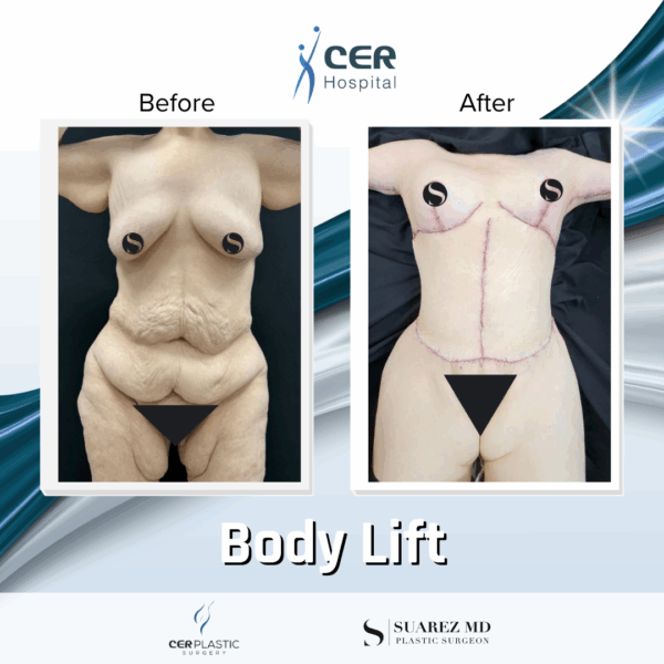 Body Lift - 24104 - Image 6