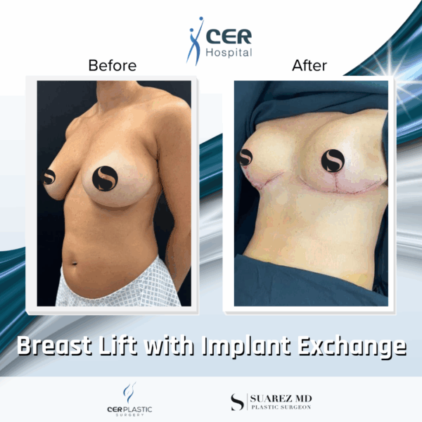 Breast Lift with Implant Exchange - 28104 - Image 6