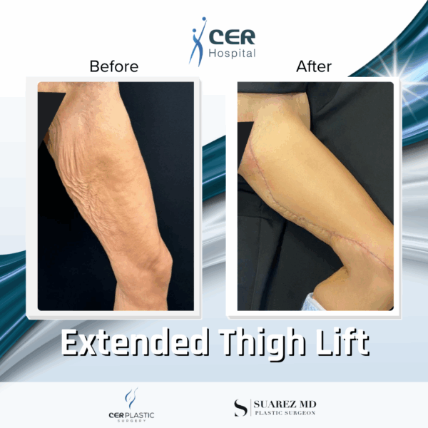 Extended Thigh Lift - 30104