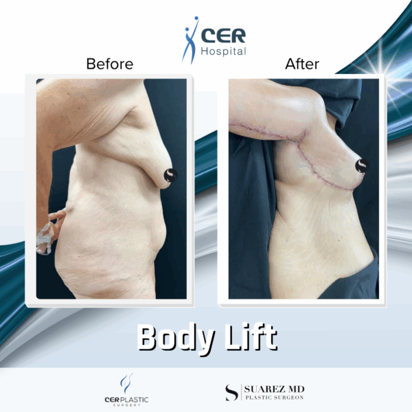Body Lift - 10124 - Image 6