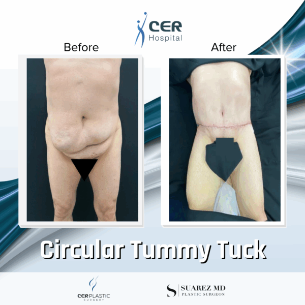 Circular Tummy Tuck - 11124 - Image 5