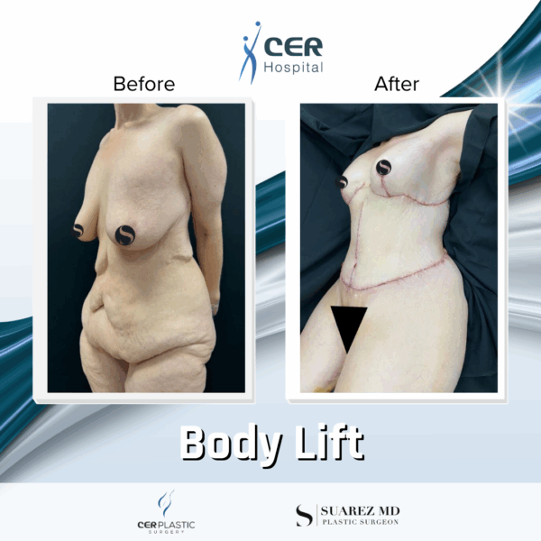 Body Lift - 18124