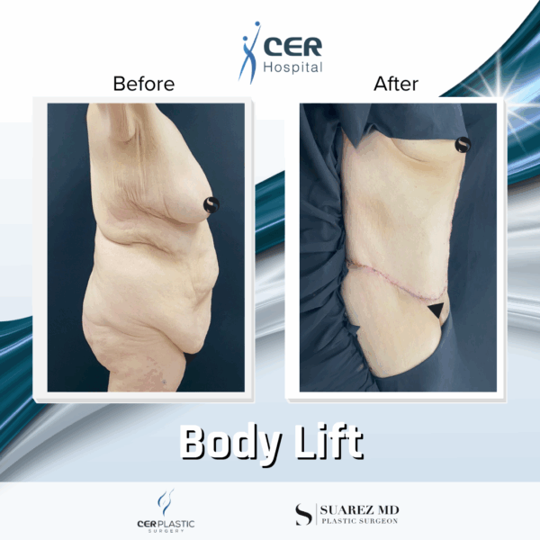 Body Lift - 7013 - Image 6