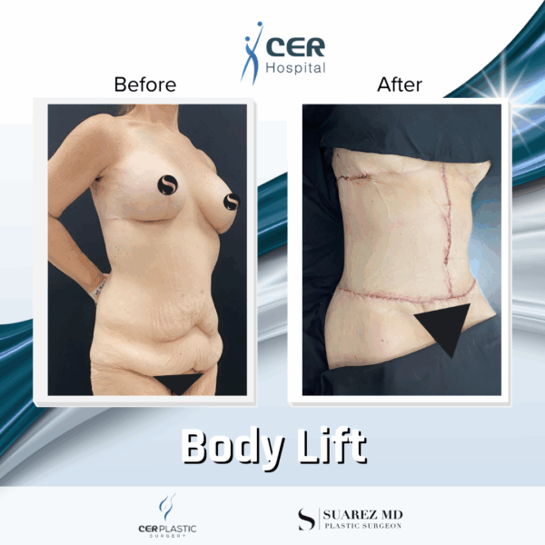 Body Lift - 8013 - Image 6