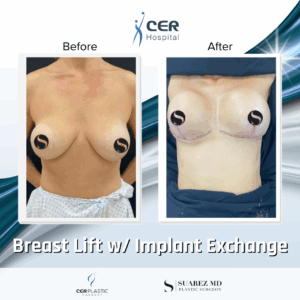 Breast Lift with Implant Exchange – 9013