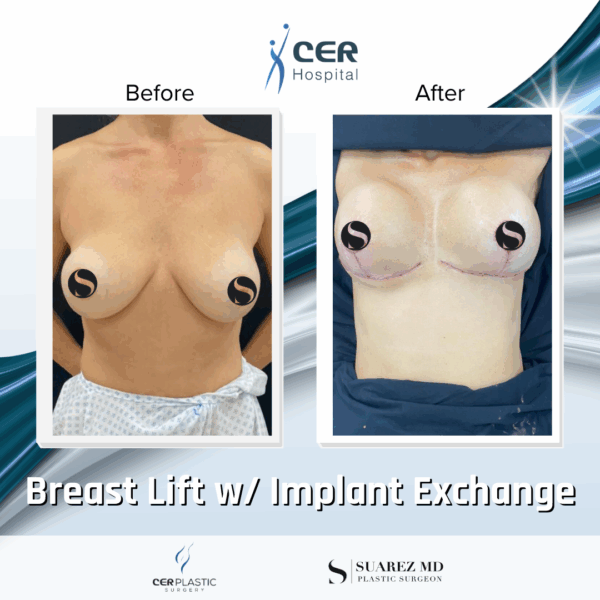 Breast Lift with Implant Exchange - 9013