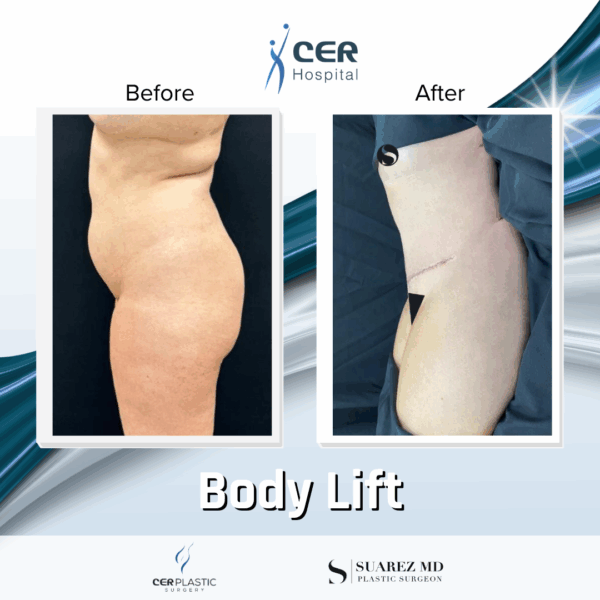 Body Lift - 16084 - Image 5