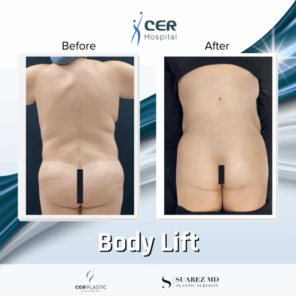Body Lift - 11013 - Image 5