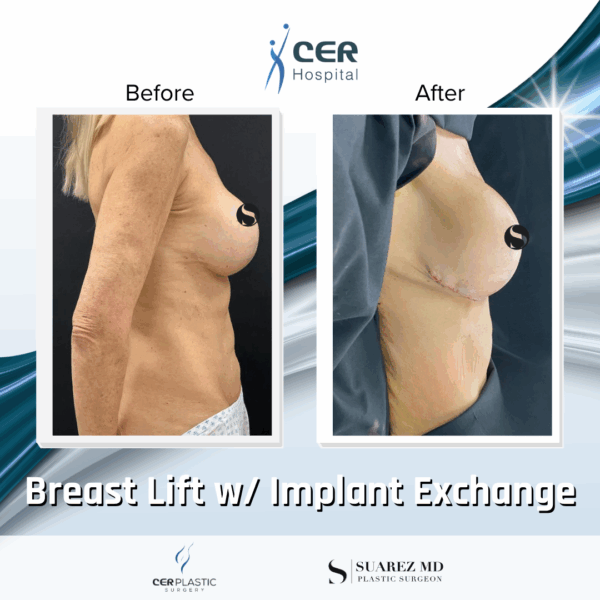 Breast Lift with Implants - 13013 - Image 6