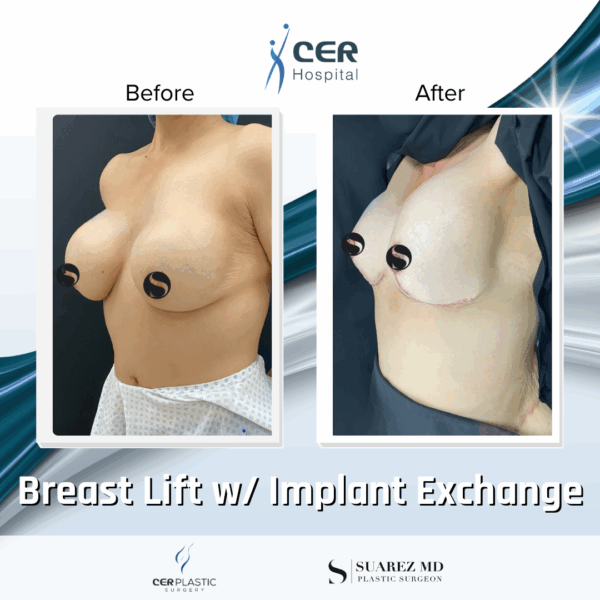 Breast Lift with Implant Exchange - 16013 - Image 5