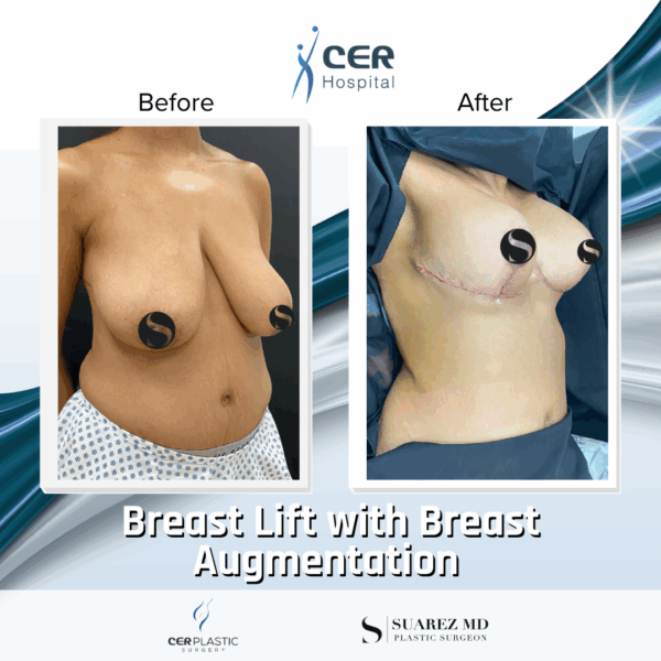 Breast Lift & Breast Augmentation - 16013 - Image 6