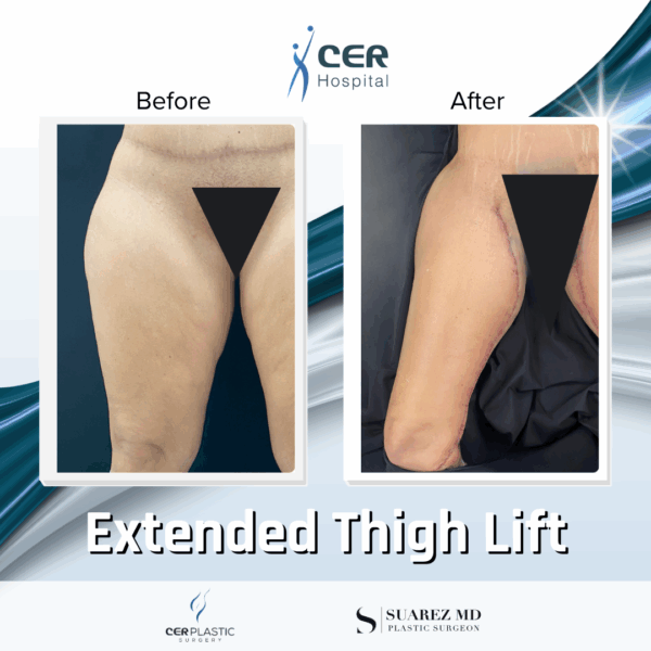 Extended Thigh Lift - 18013 - Image 5