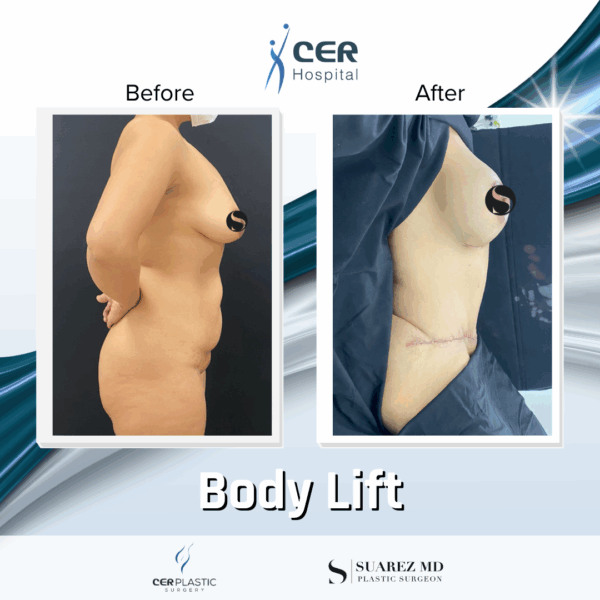 Body Lift - 18013 - Image 6