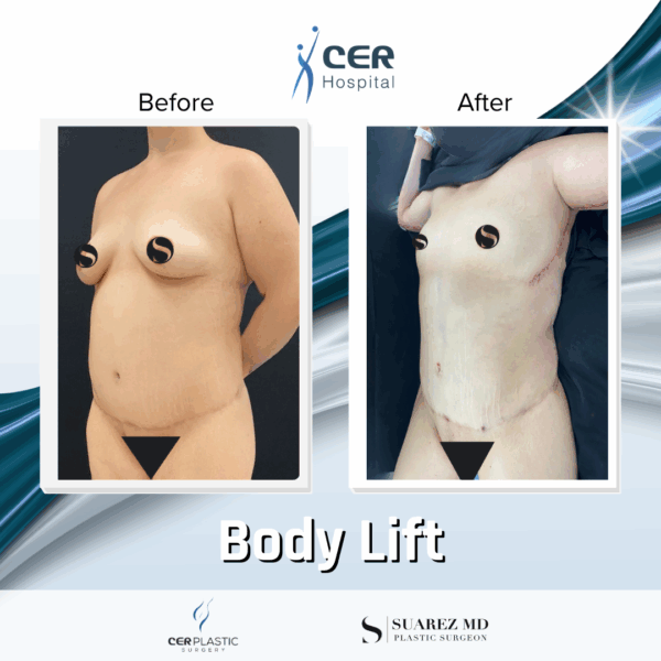 Body Lift - 20013 - Image 6