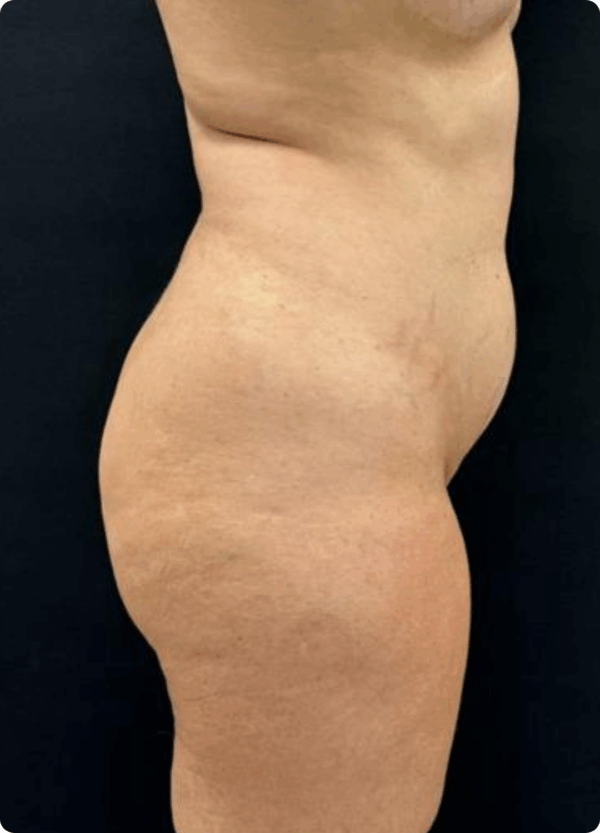 Body Lift - 16084 - Image 3