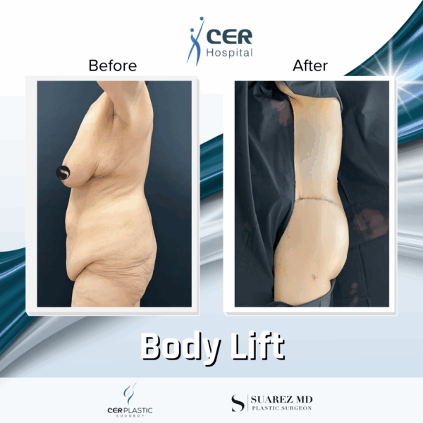 Body Lift - 23013 - Image 5
