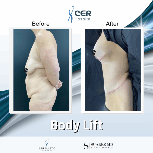 Body Lift - 13121 - Image 5