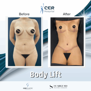 Body Lift – 26043