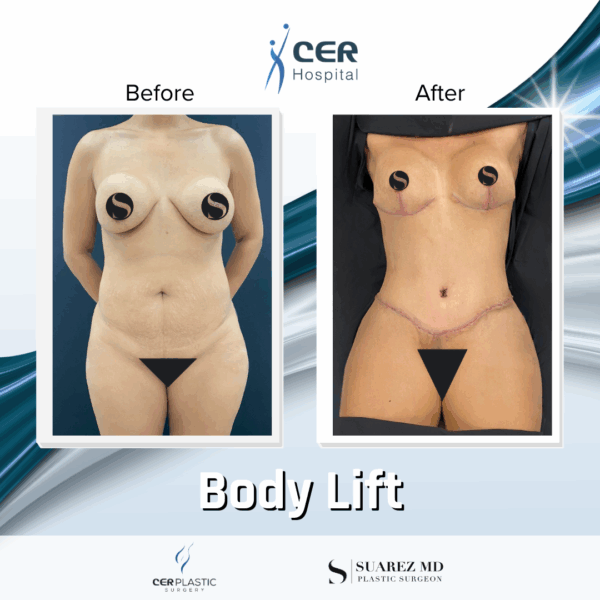 Body Lift - 26043