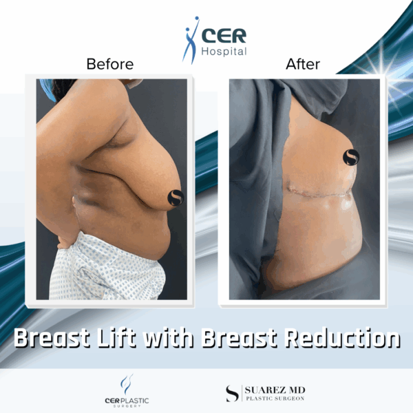 Breast Lift with Breast Reduction - 19043 - Image 5