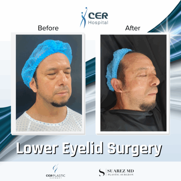 Lower Eyelid Surgery - 21043 - Image 6
