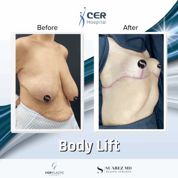 Body Lift - 10043 - Image 6