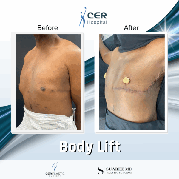 Body Lift - 19043 - Image 6
