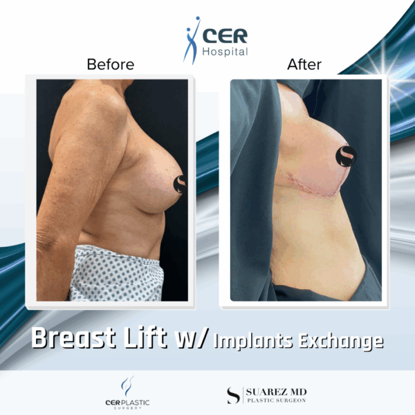 Breast Lift with Implant Exchange - 26084 - Image 6