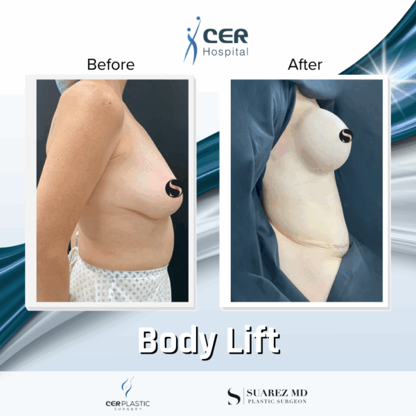 Body Lift - 5043 - Image 6