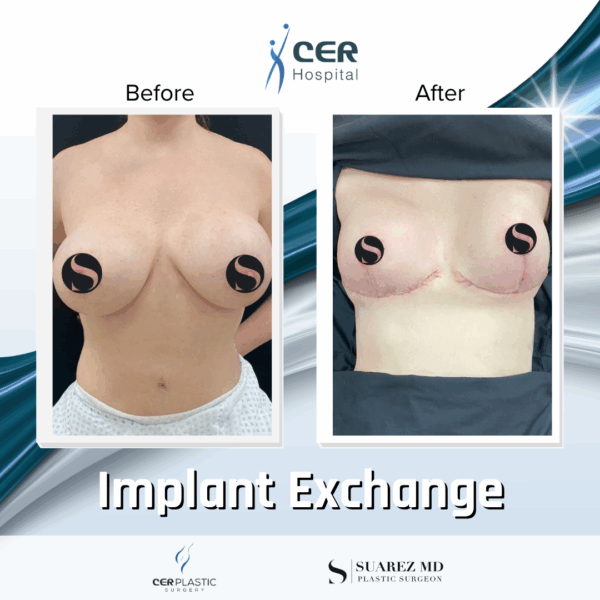 Implant Exchange - 3043 - Image 5