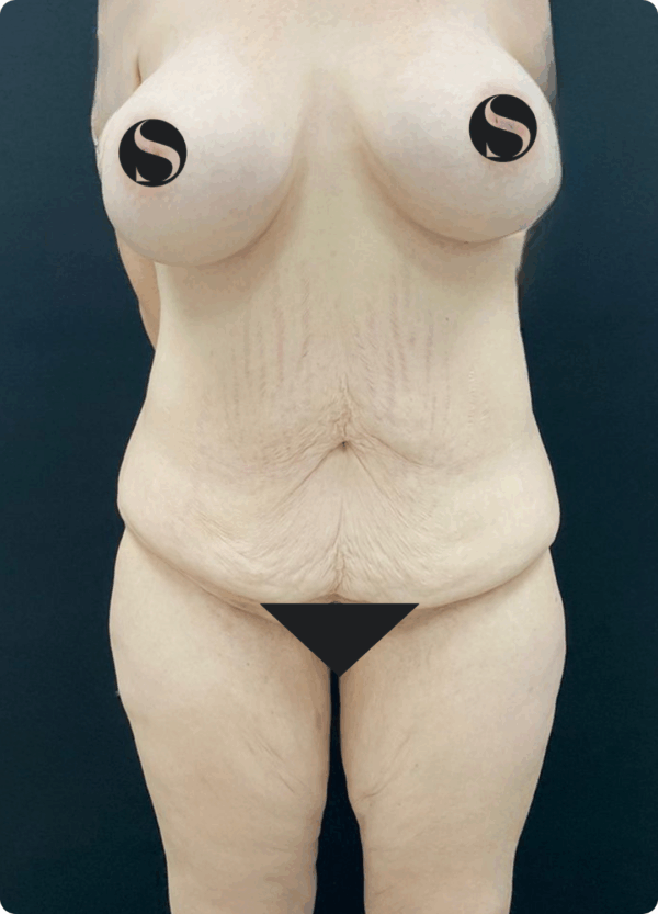 Circular Tummy Tuck - 3043 - Image 3