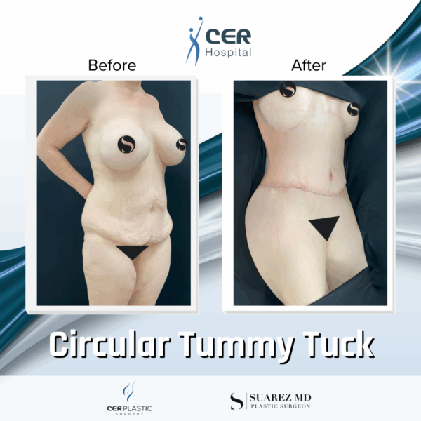 Circular Tummy Tuck - 3043 - Image 9