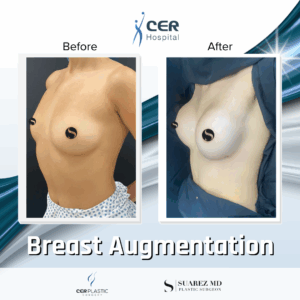 Breast Augmentation – 31053