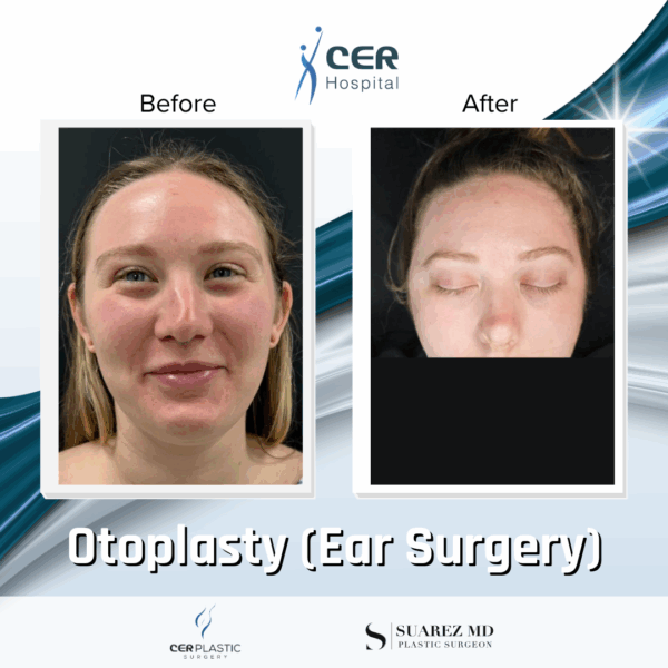 Otoplasty - 4094