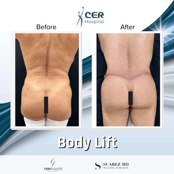 Body Lift - 2104 - Image 6