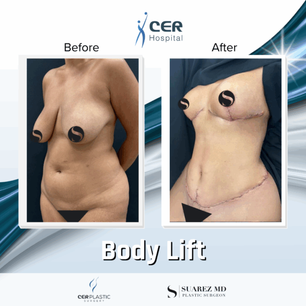 Body Lift - 20084 - Image 7