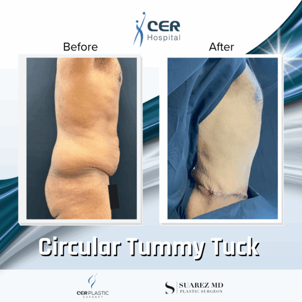 Circular Tummy Tuck - 11104 - Image 7