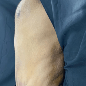 Circular Tummy Tuck – 11104