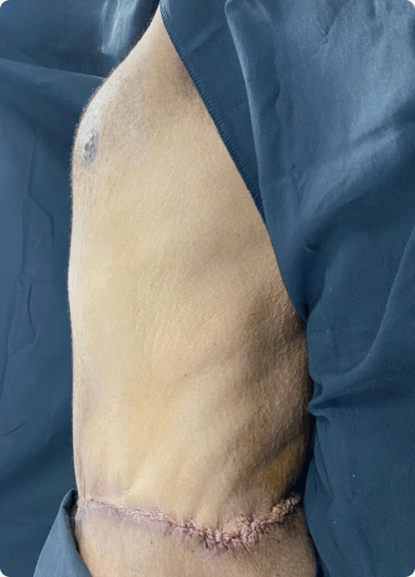 Circular Tummy Tuck - 11104 - Image 2
