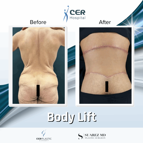 Body Lift - 3074